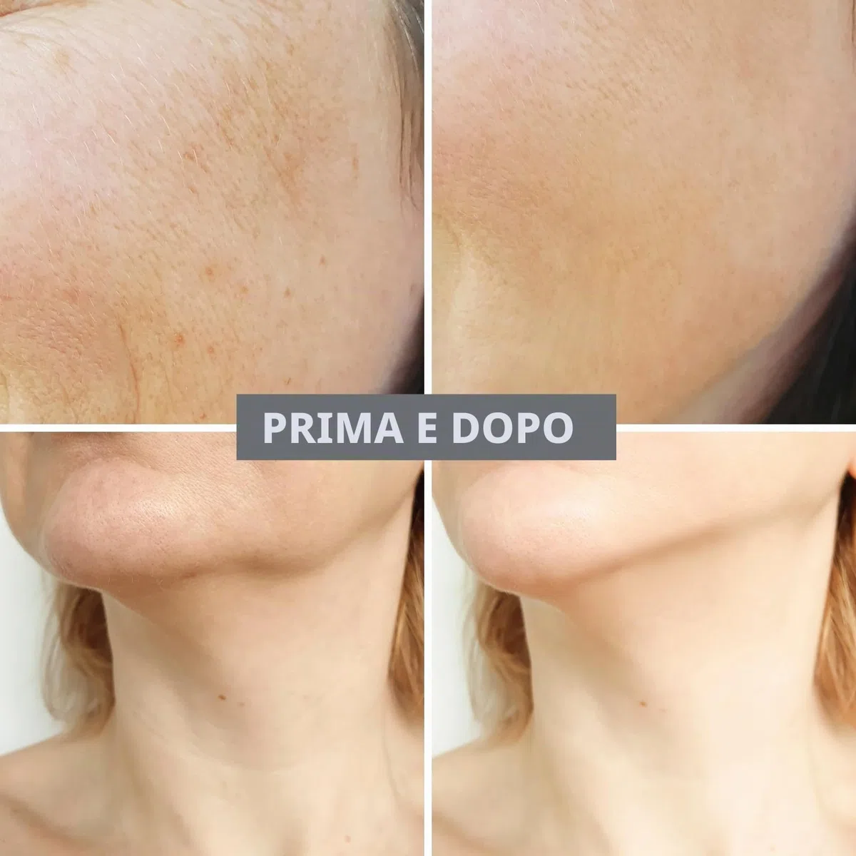 Set di Sistema di Infusione con Microneedling, incluso Hydra Needle da 0,5 mm 1 pezzo, 2 Testine di Ricambio e 3 Fiale di Siero Anti-Invecchiamento da 5 ml, Trattamento Anti-Invecchiamento