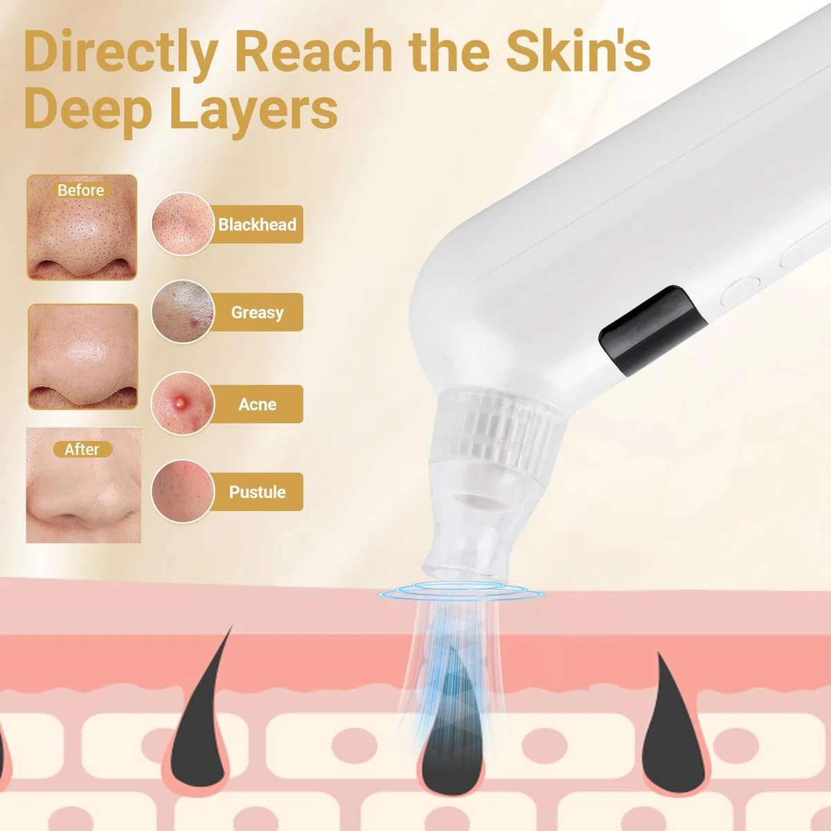 UCAMP Aspiratore Punti Neri, Professionale Elettrico Comedone con 5 Modalità 6 Testine Applicazione di Calore, Pulizia Viso Tramite Rimozione Pori, per Tutti i Tipi Pelle(con Estrattore di Acne Kit)