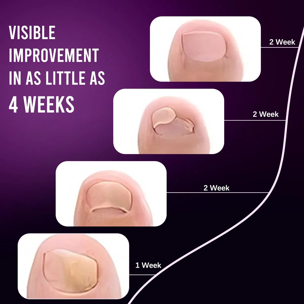 Dispositivo Trattamento Laser Micosi Unghie,Terapia Luce Blu UV Infrarossi, Rigenerazione Unghie Danneggiate Unghie Terapia Laser Portatile Luce Infrarossa 910nm e Blu 460nm per Unghie e Unghie Piedi