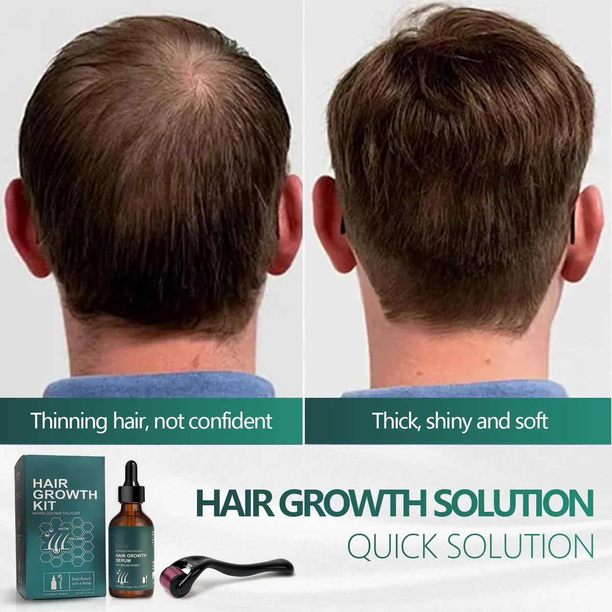 Kit crescita capelli Con Roller Set, Siero per La Crescita Dei Capelli, 60 ml siero per la crescita dei capelli, per Capelli Più Spessi, Lunghi per Uomini Donne